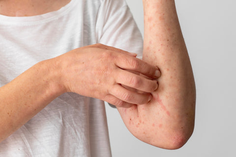 5 things you should try to prevent being Itchy skin